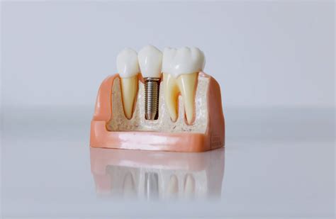 cheapest dental implants abroad.